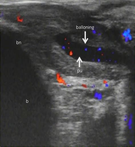 can guys squirt|Male squirting: Analysis of one case using color Doppler ...